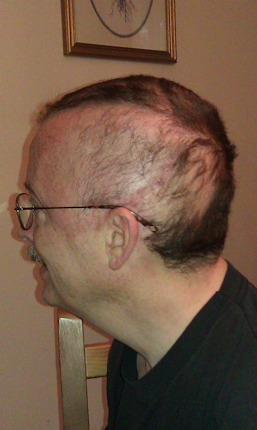 Losing hair, day 14 of radiology.